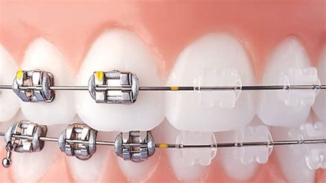 brackets ceramicos y metalicos|Brackets Cerámicos Vs Metálicos: 7 Diferencias .